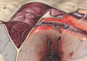 Patients in liver failure after using knock-off weight loss drug
